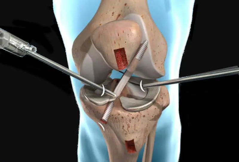 ACL surgery Perth or Perth knee replacement surgery Perth Australia.
